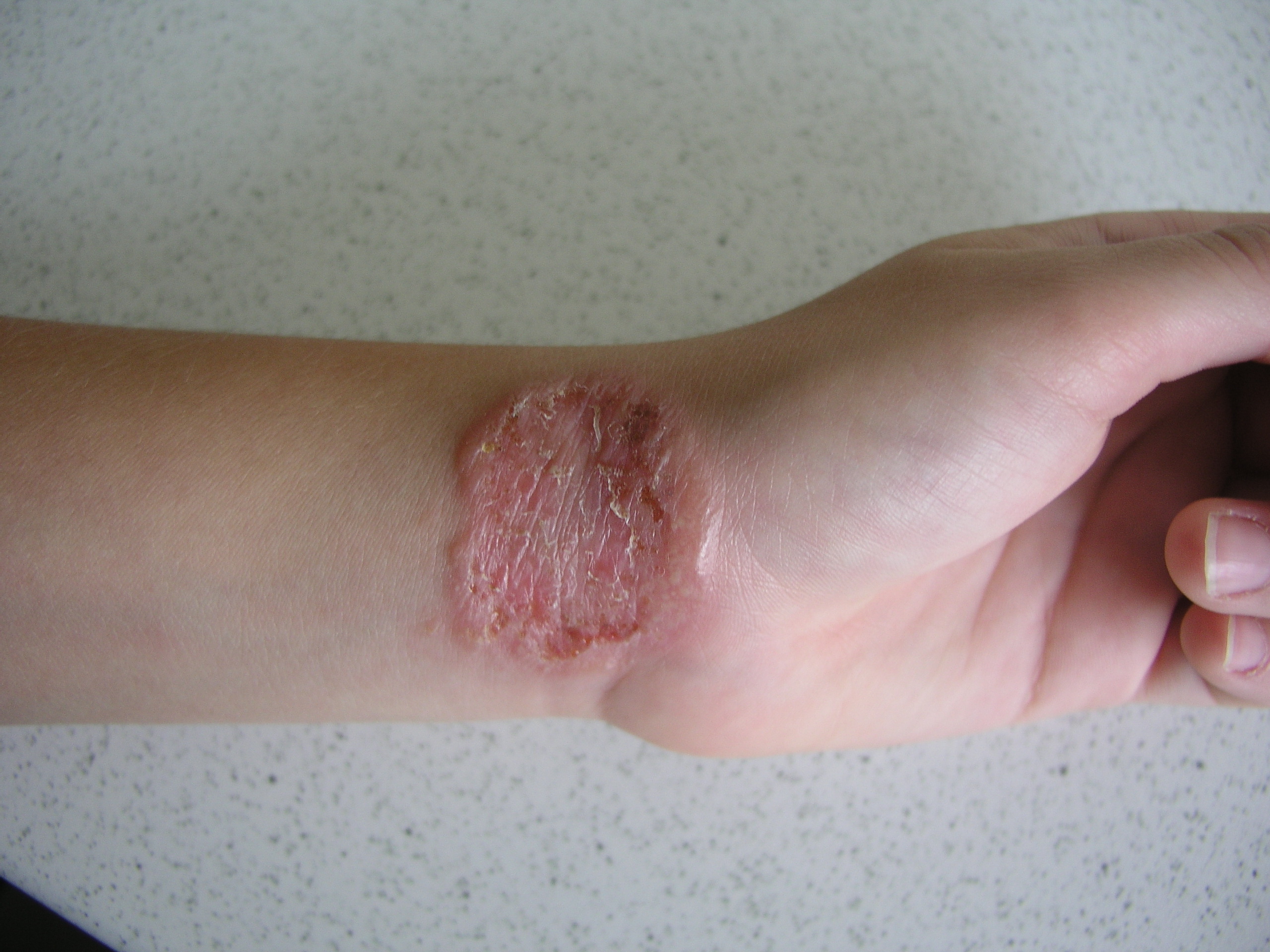 Trichophyton sp. D 604 A. benhamiae Mallatova